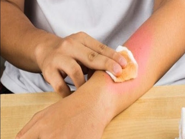 Xử l&yacute; khi bị bỏng do dầu mỡ đơn giản, hiệu quả